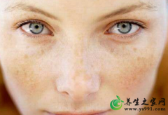 什么是瘀血体质？血瘀体质的特点特征及表现