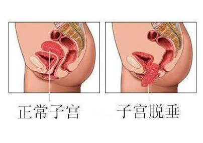 子宫脱垂的防治与治疗方法_子宫脱垂的手术与非手术治疗方法