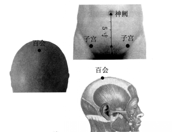 子宫脱垂针灸有效果吗?子宫脱垂体针治疗穴位及方法