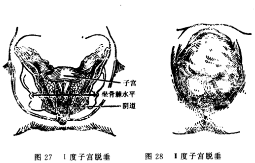 子宫脱垂有什么症状吗?子宫脱垂早期的感觉和表现