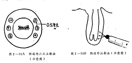 治疗子宫脱垂​子宫旁组织注射疗法的操作方法