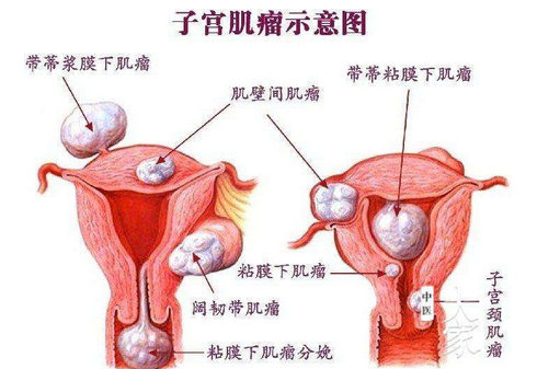 子宫肌瘤必须要做手术吗?什么情况下子宫肌瘤需要手术?
