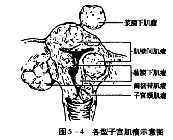 长了子宫肌瘤一定要手术吗?子宫肌瘤必要手术治疗吗?