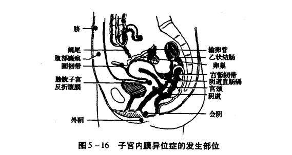 子宫内联异位症与子宫腺肌病是一回事吗？