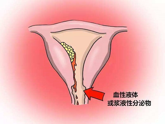 阴道流血都是月经吗？不是生理期却少量出血咋回事?