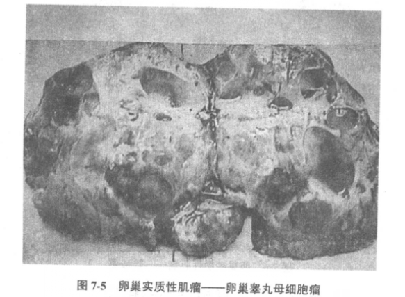 子宫肌瘤盆腔包块证相鉴别的疾病