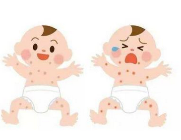 桂枝汤加味治疗小儿湿疹医案案例