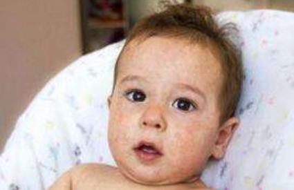 麻黄附子细辛汤加味治疗小儿湿疹医案案例