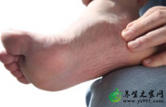 痛风的自我检查_如何自测是否得了痛风