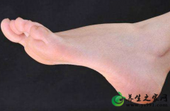 痛风治疗的3个阶段_痛风急性发作期如何缓解