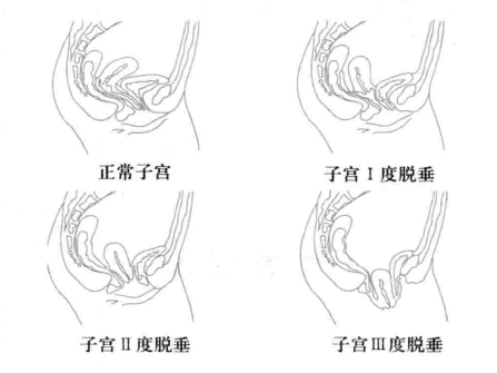 产后子宫脱垂的分级与诊断方法
