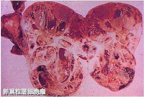 卵巢瘤不必急着手术吗？卵巢瘤必须要手术治疗吗?