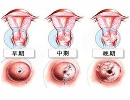 绝经后出现不规则阴道流血一定是得了子宫内膜癌吗？
