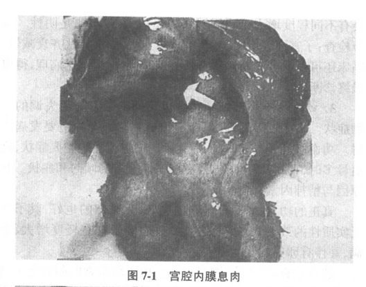 与子宫流血症状的子宫肌瘤相鉴别的疾病