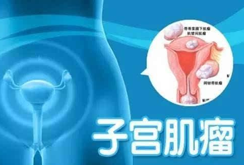 子宫肌瘤是种什么病？