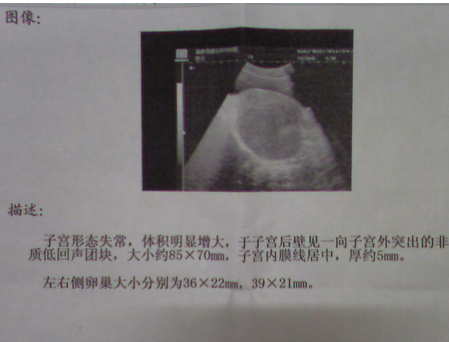 子宫肌瘤的B超诊断与鉴别诊断