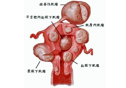 子宫肌瘤的大体解剖形态是怎样的？