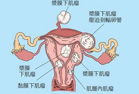 子宫肌瘤与子宫内膜异位症共同点与区别