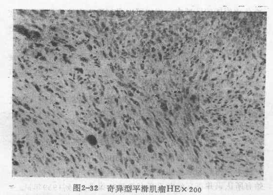 什么是奇异型平滑肌瘤?