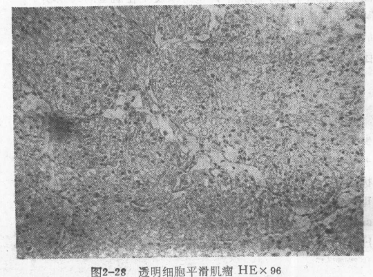 什么是子宫上皮样平滑肌瘤?上皮样平滑肌瘤的3大类型