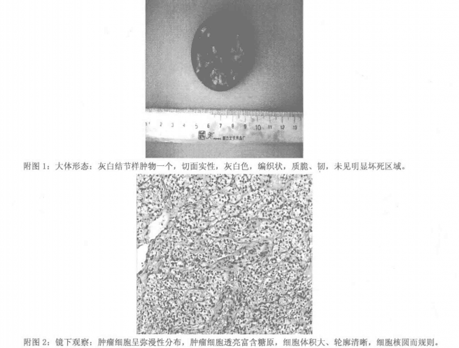子宫粘膜下上皮样平滑肌瘤患者康复治愈案例