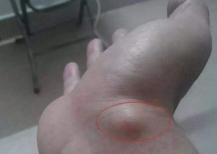 腱鞘囊肿针刺治疗方法与注意事项_腱鞘囊肿针刺后能好吗？