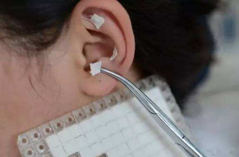 妇科疾病耳压疗法管用吗？妇科耳压法的适应症与注意事项