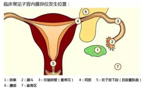 子宫内膜异位症灸哪些部位好？穴位治疗的效果、注意事项