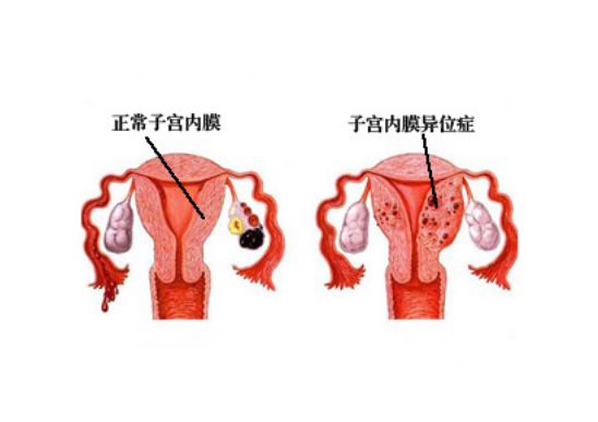 子宫内膜异位症中药贴敷管用吗？贴敷疗法中药方与效果、注意事项