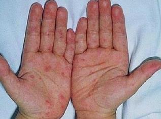 中药浸泡治疗手足癣效果与方法、经验