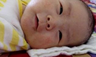 桑菊饮湿敷治疗婴儿湿疹效果与方法、经验