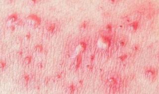 中西医结合治疗复发性生殖器疱疹效果与方法、经验