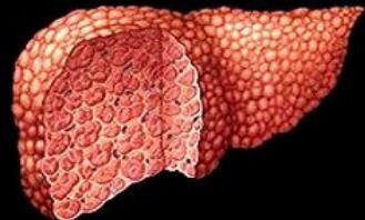 调气解毒法治疗慢性乙型病毒性肝炎效果与方法、经验