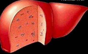 自拟慢性乙肝方治疗慢性乙型病毒性肝炎效果与方法、经验