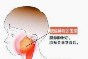 釜底抽薪散治痄腮方法