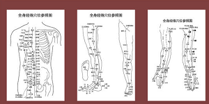 落枕针灸治疗处方与部位方法_针刺哪里穴位效果最好