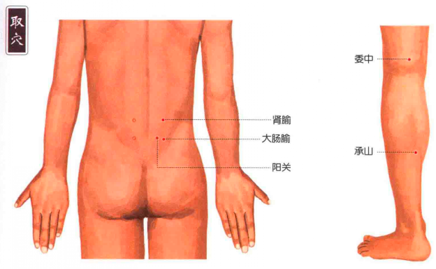 闪腰岔气可以拔罐吗_闪腰岔气拔罐方法与配穴