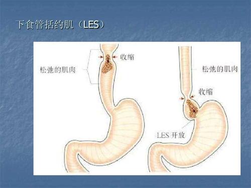 邓铁涛食管贲门失弛缓症方的配方组成、作用与功效、适应症