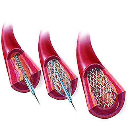 潘澄濂冠心病方方二的配方组成、作用与功效、经验