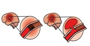颜德馨缺血性中风方的配方组成、作用与功效、经验