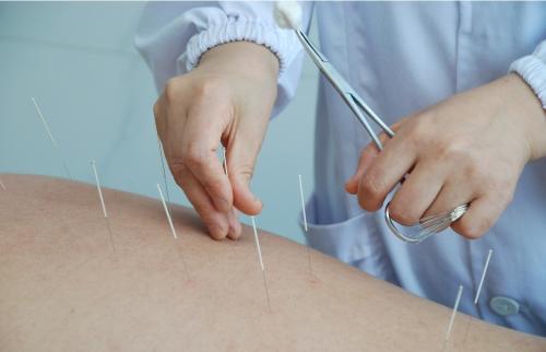 针灸加耳穴贴压1治疗失眠的方法、穴位、医案