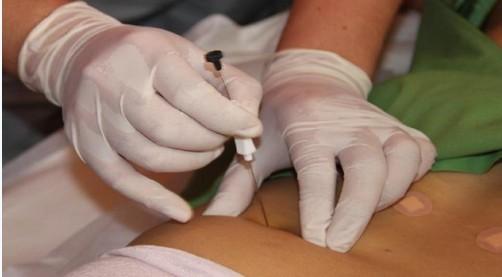 穴位埋线法治疗习惯性便秘配方、医案、经典案例