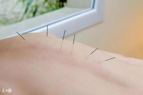 刺络拔罐疗法治疗腰部软组织损伤配方、医案、经典案例