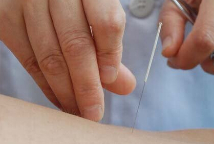 指针承山穴区治疗急性腰扭伤配方、医案、经典案例