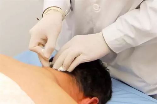 梅花针叩刺治疗痔疮配方、医案、经典案例