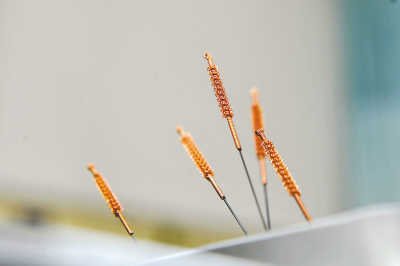 火针治疗治疗类风湿关节炎方法、医案、经典案例