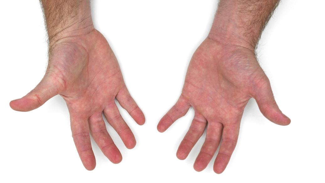 痛风合剂治疗痛风性关节炎配方、医案、经典案例