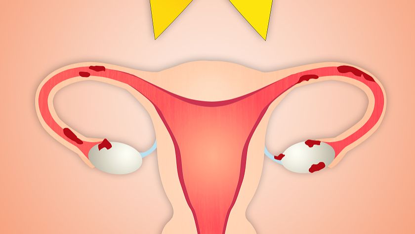 调经助孕促排卵汤治疗排卵障碍性不孕配方、医案、经典案例