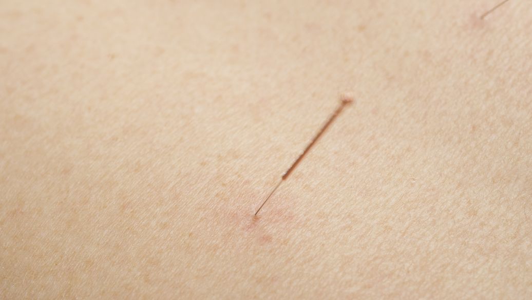 针灸治疗女性不孕症1医案、经典案例