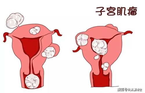 中西医结合治疗流产后内分泌功能失调性不孕症医案、经典案例
